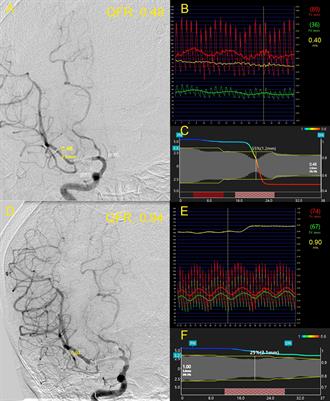 Functional Assessment of Cerebral Artery Stenosis by Angiography-Based Quantitative Flow Ratio: A Pilot Study